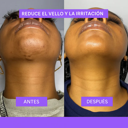 Fiorea Reduce Vellos Desde La Raíz "Cyperus Rotundus" - OFERTA 2X1