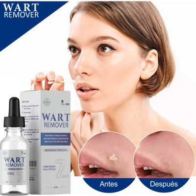 Wart Remover | Removedor de verrugas y lunares